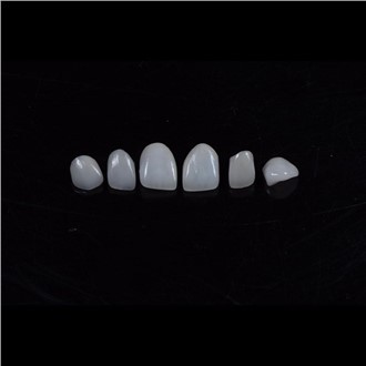 Emax porcelænsfiner