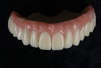 Midlertidig krone af akrylharpiks